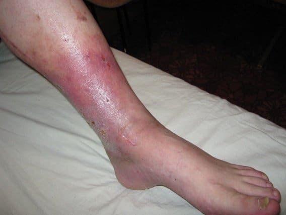 Зуд при варикозе: причины, лечение (медикаменты, народные средства, диетотерапия), возможные осложнения (трофические язвы, дерматит, экзема)