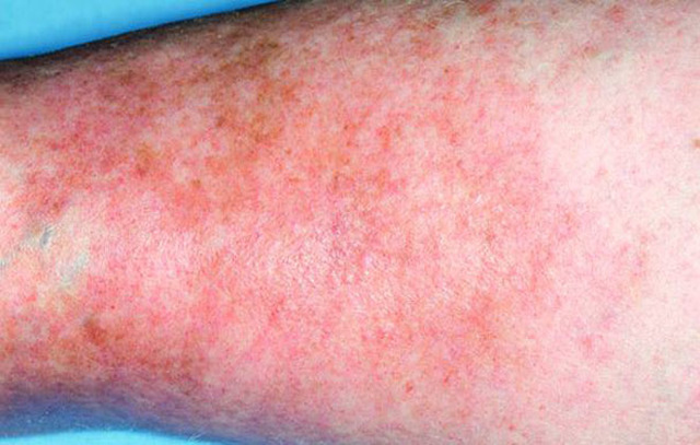 Зуд при варикозе: причины, лечение (медикаменты, народные средства, диетотерапия), возможные осложнения (трофические язвы, дерматит, экзема)