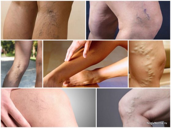 Зуд при варикозе: причины, лечение (медикаменты, народные средства, диетотерапия), возможные осложнения (трофические язвы, дерматит, экзема)