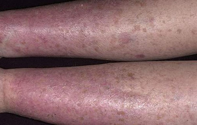 Зуд при варикозе: причины, лечение (медикаменты, народные средства, диетотерапия), возможные осложнения (трофические язвы, дерматит, экзема)