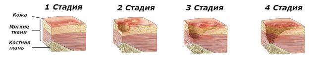 Зуд при варикозе: причины, лечение (медикаменты, народные средства, диетотерапия), возможные осложнения (трофические язвы, дерматит, экзема)