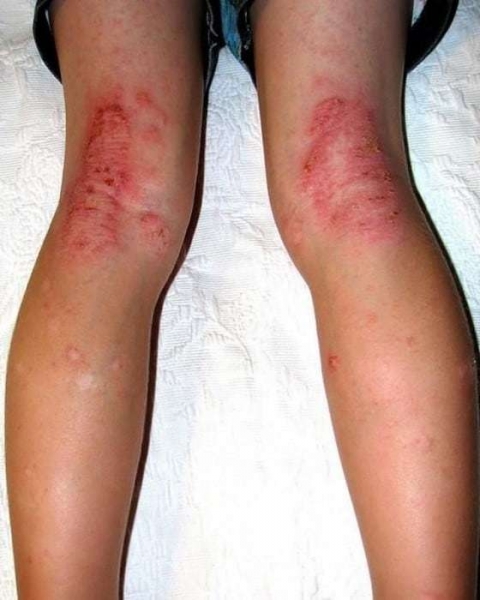 Зуд при варикозе: причины, лечение (медикаменты, народные средства, диетотерапия), возможные осложнения (трофические язвы, дерматит, экзема)