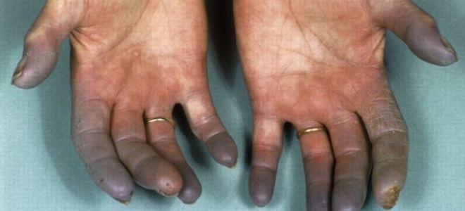 Вибрационная болезнь (вибротравма)