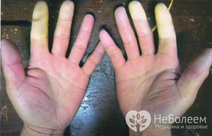 Вибрационная болезнь (вибротравма)