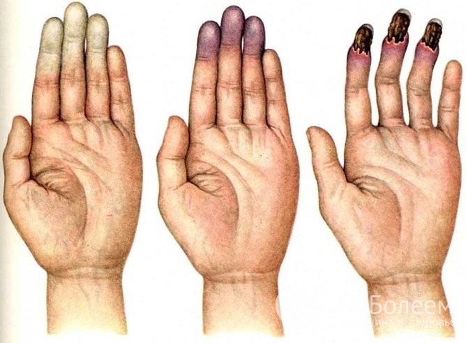 Вибрационная болезнь (вибротравма)