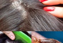 Вши у детей: причины появления, особенности лечения и профилактики