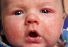 Почему у детей бывает дерматит