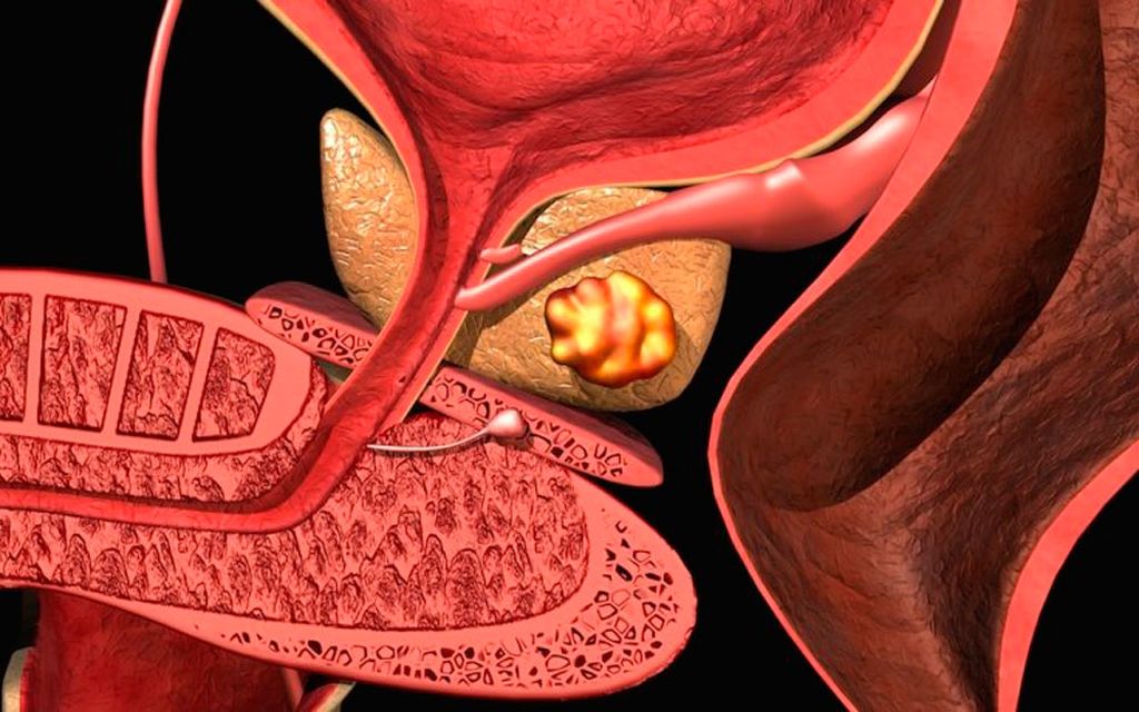 Рак простаты: 12 ранних симптомов, которые мужчины никогда не должны игнорировать