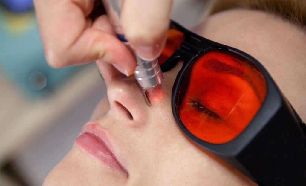 Лечение купероза: основные методы терапии