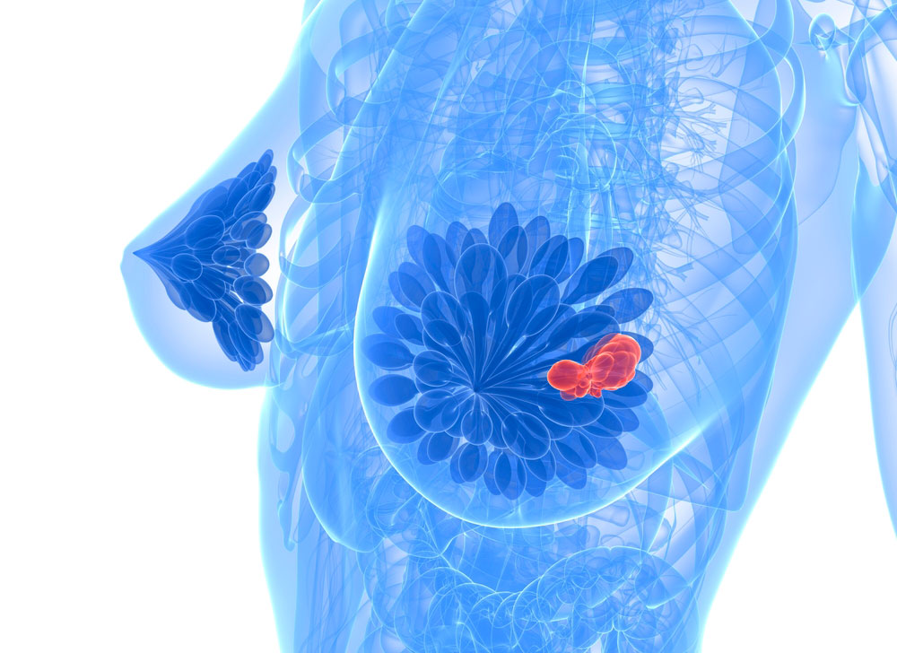 Как диагностируют кисту молочной железы