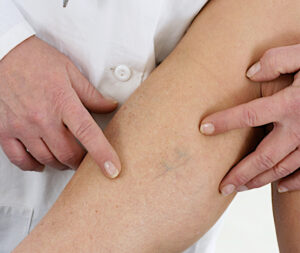 Попрощайтесь с сосудистыми звездочками: Преимущества и процедура лазерного лечения сосудистых поражений