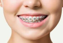 Исправление прикуса: руководство по исправлению прикуса в стоматологии