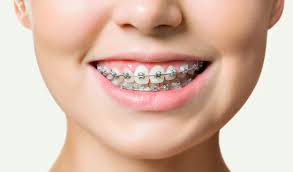 Исправление прикуса: руководство по исправлению прикуса в стоматологии