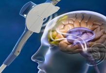 Исследование транскраниальной магнитной стимуляции: многообещающий терапевтический метод