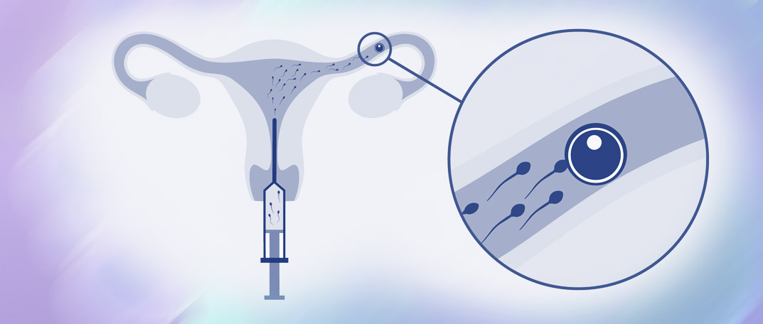 Внутриматочная терапевтическая система: улучшение женского здоровья