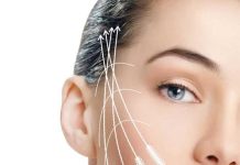 Нитевой лифтинг нитями Aptos: что необходимо знать