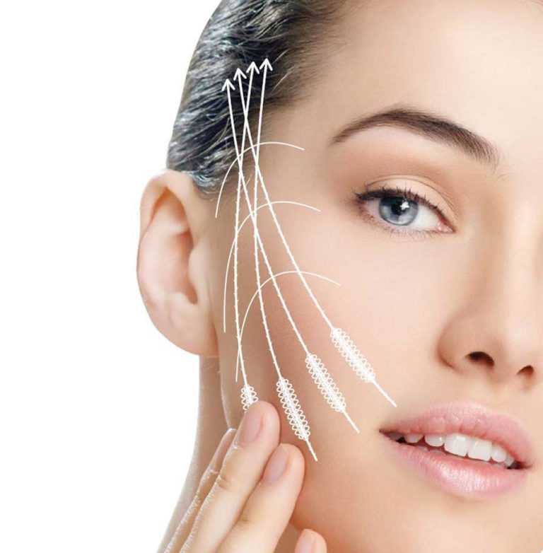 Нитевой лифтинг нитями Aptos: что необходимо знать