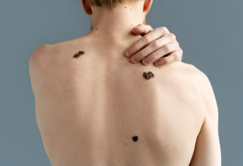 Бородавки: всё, что нужно знать о этих неприятных образованиях